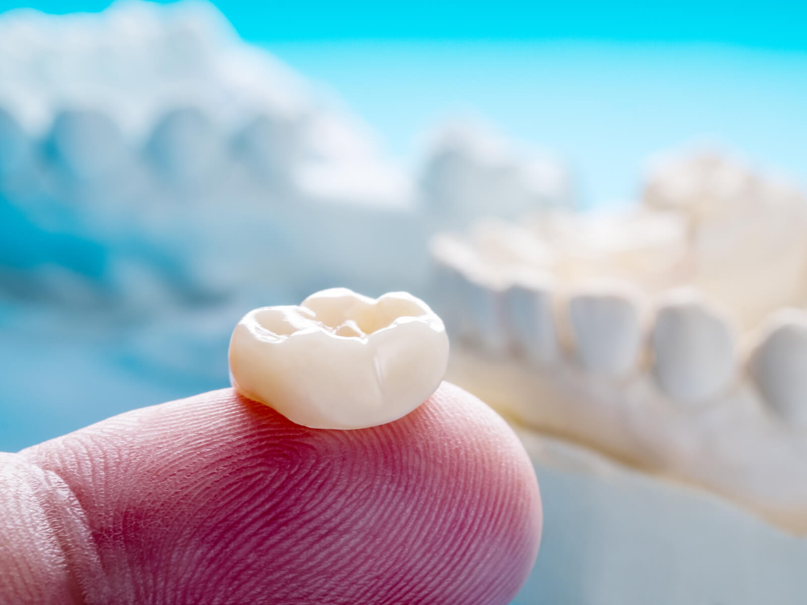 When A Dental Crown May Need To Be Replaced?