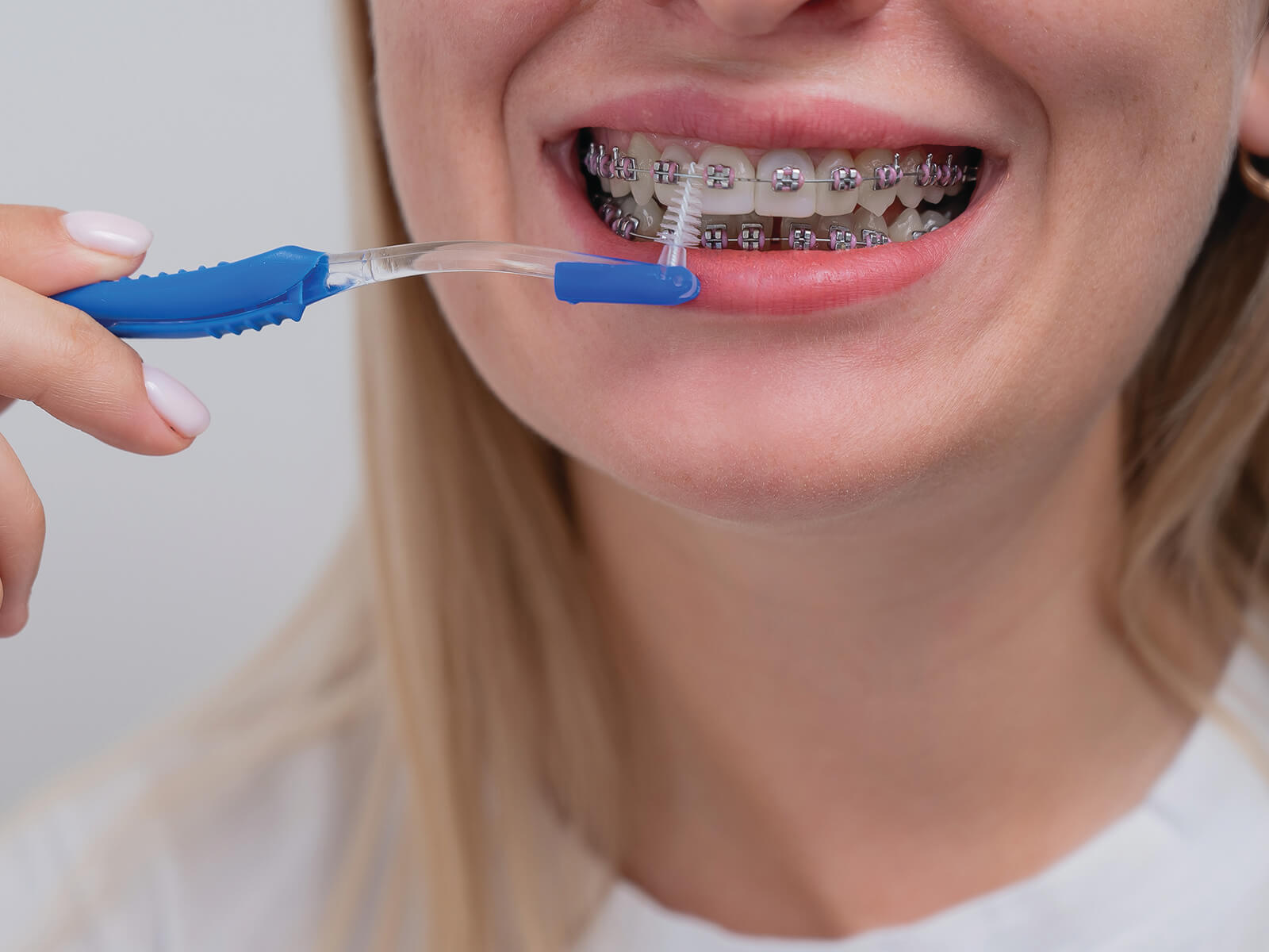 Do You Need Dental Care While You Have Braces?