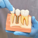 5 Tips To Increase Dental Implant Longevity