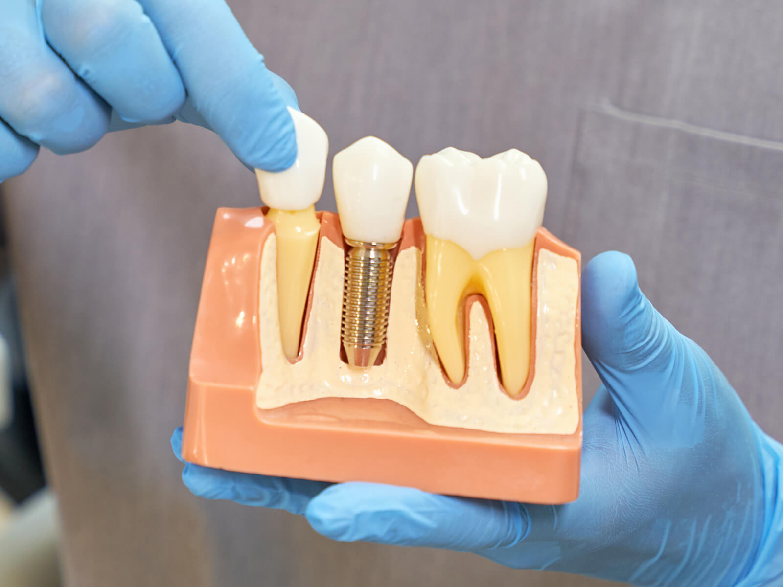 5 Tips To Increase Dental Implant Longevity