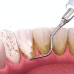 5 Tips For Preparing For Teeth Cleaning