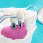 Can A Dental Implant Replace A Bridge?