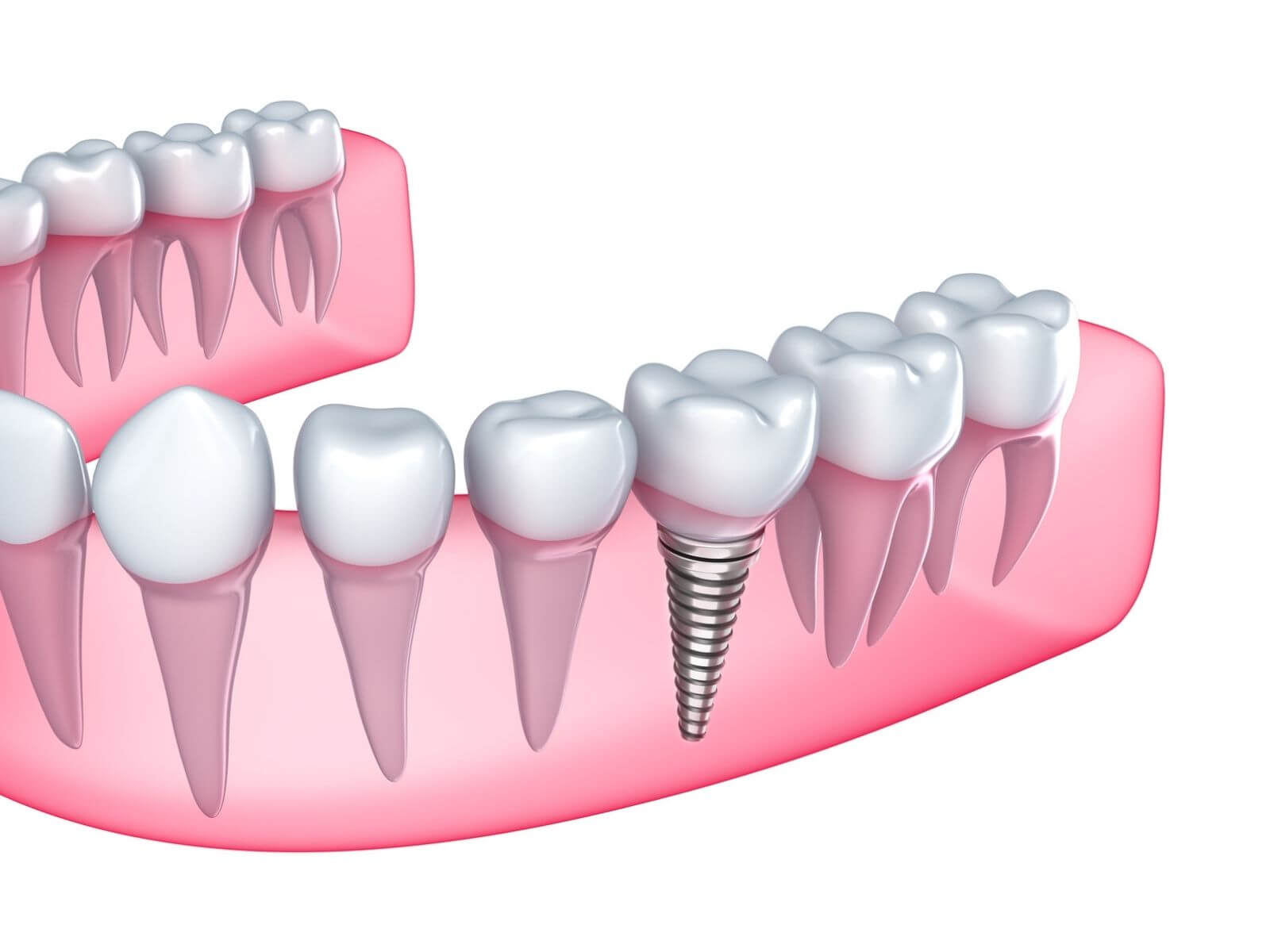 Top 10 Benefits of Full Mouth Dental Implants