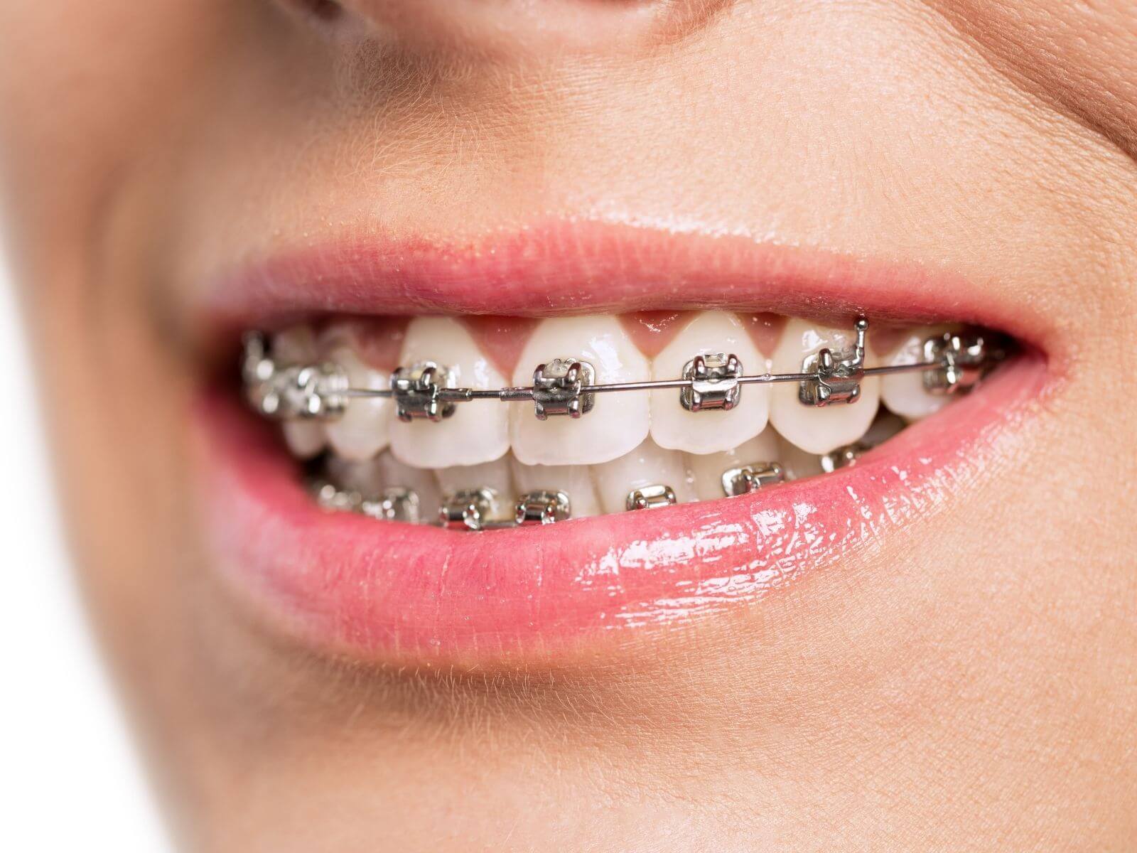 Everything You Should Know About Braces For Kids