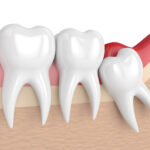 Find Out The Common Signs Of Infection After A Tooth Extraction